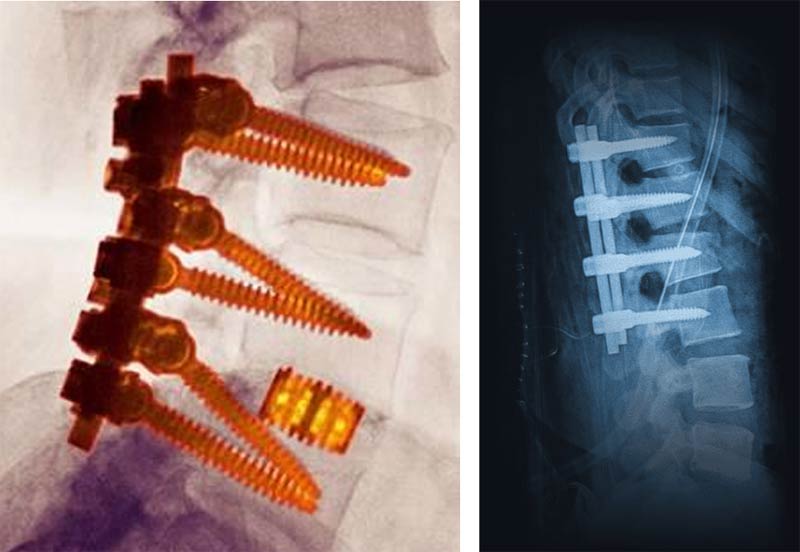 Spine treated with screws and rods for lumbar fusion