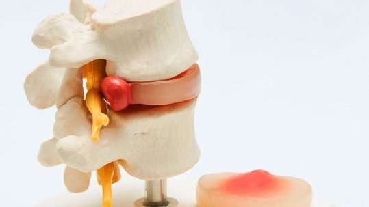 Groudbreaking New Study Shows Discseel Procedure Effective For Chronic Spine And Leg Pain